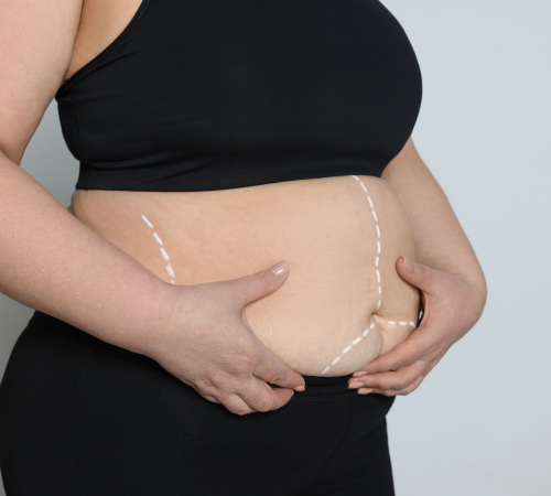 Bariatric Surgery